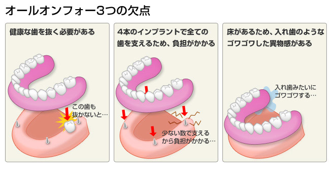 一般的に使用されているオールオンフォーの欠点
