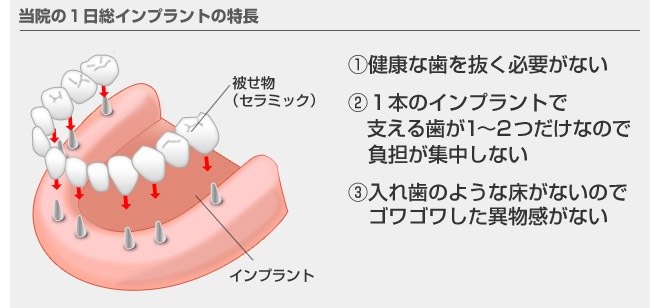 一般的に使用されている純チタンインプラントの欠点